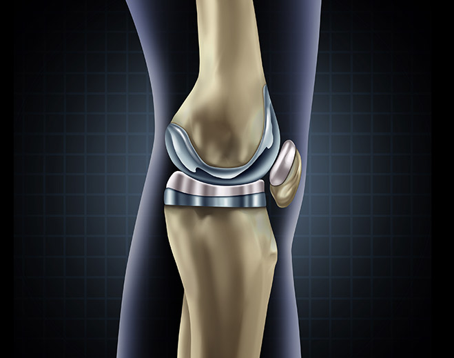 ortopedia-reemplazo-de-rodilla