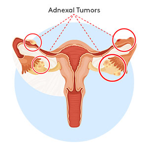 adnexal-tumors