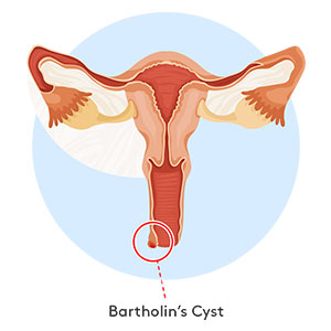 bartholins-cyst