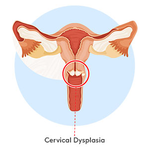 cervical-dysplasia