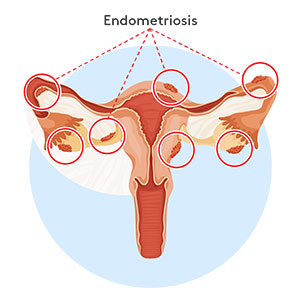 endometriosis