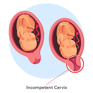 incompetent-cervix