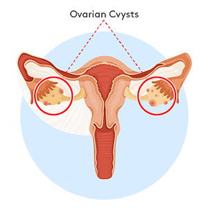 ovarian-cysts