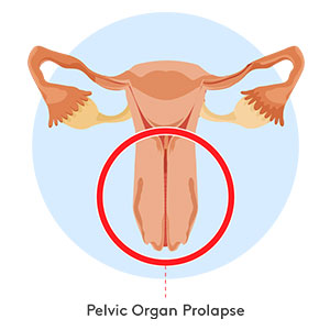 pelvic-organ-prolapse