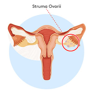 struma-ovarii