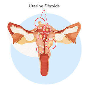 uterine-fibroids